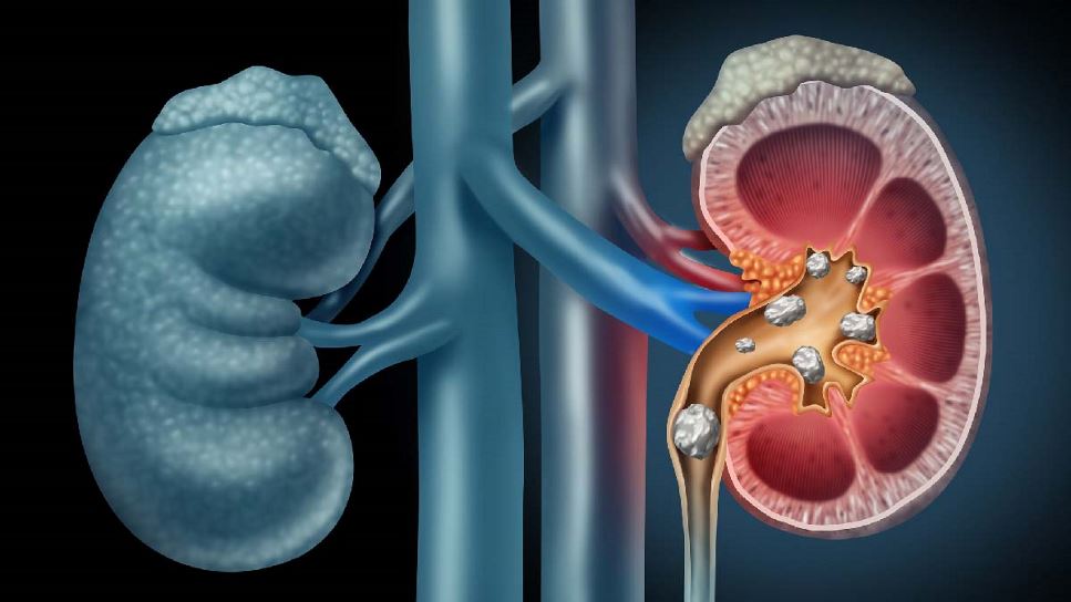 Kidney Stone Nutrition: So Much More Than Oxalate | Image of a Pair of Kidneys, one bisected
